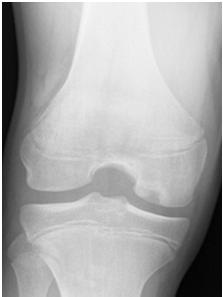 Osteochondritis Dissecans Unknown etiology Cause for