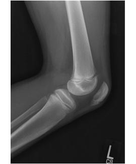 Infrapatellar Tendonitis/ Sinding-Larsen-Johansson Symptoms similar to Osgood-Schlatter Location at inferior pole of patella Tx: Rest Ice Stretching Anterior Knee Pain Vague, periarticular pain in