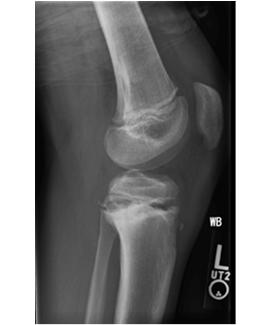 Physeal Fracture Not a knee sprain Bony tenderness at physis of distal femur,