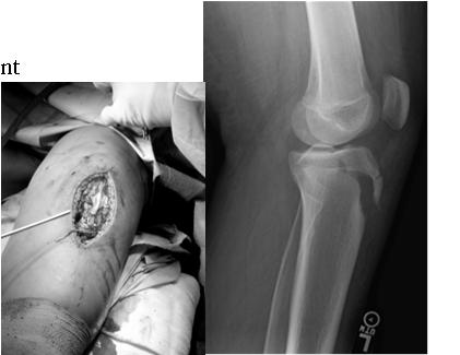 Tibial Tuberosity Fracure Strong eccentric quad contraction Risk for compartment syndrome