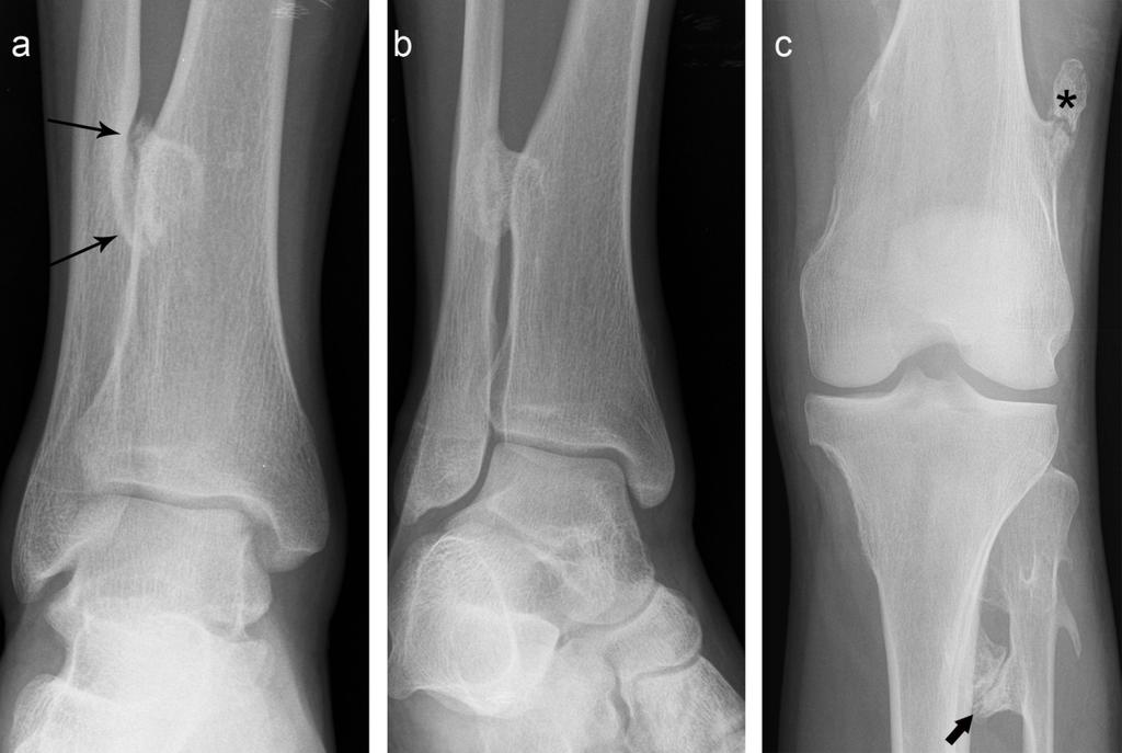 (b) Lateral radiograph of the left knee demonstrates abnormal contact between the osteochondroma and the fibula which created a large pressure erosion involving > 50% the width of the fibular