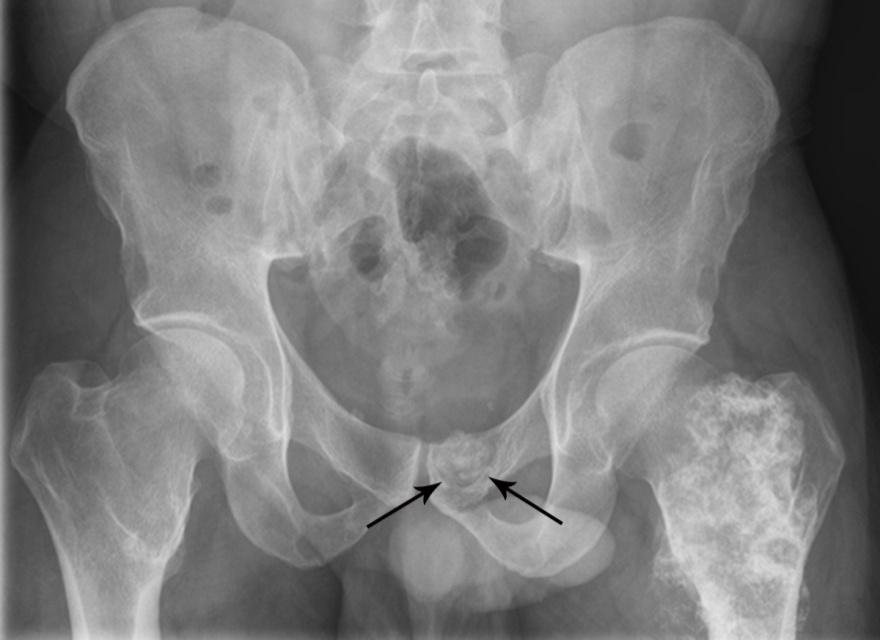 522 The Open Orthopaedics Journal, 2015, Volume 9 Davis and Mulligan Case 3 A 41-year-old male with a history of HME presented to his neurosurgeon with new-onset of left buttock pain, following