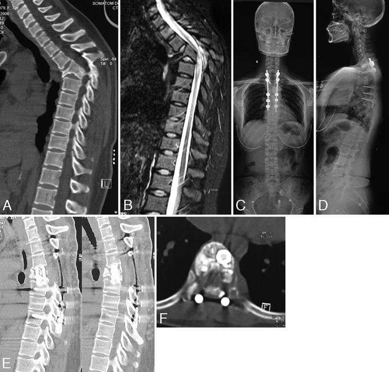 Modified VCR for thoracolumbar angular kyphosis correction Fig. 3. Thirty-year-old woman with old tuberculosis kyphosis.