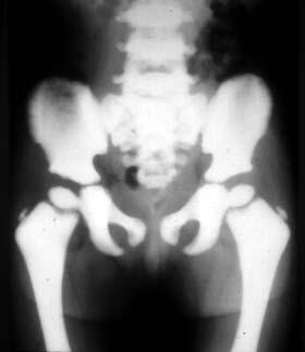 Osteoporosis 10 Osteopetrosis