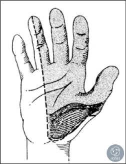 Palmar aspect of thumb, index, long and radial half of ring fingers Dorsal aspect of fingers distal to the PIP joint Regional Review