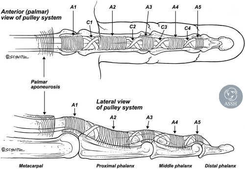Stenosing tenosynovitis Flexor tendon stuck passing under first annular (A1) pulley Anatomy of the Flexor Tendon/Pulley