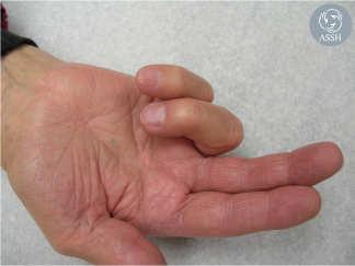 the A1 pulley is impeded The finger becomes locked in flexion Often the finger must be passively extended with a palpable