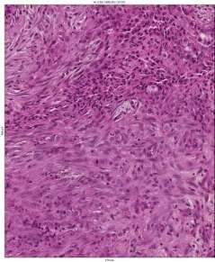 differential Mesothelioma with abundant fibroblastic