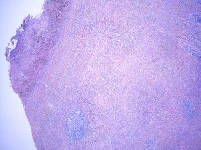 Inflammatory myofibroblastic tumor Inflammatory