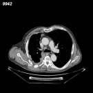 - Chest X-ray usually shows a unilateral pleural effusion or thickening.