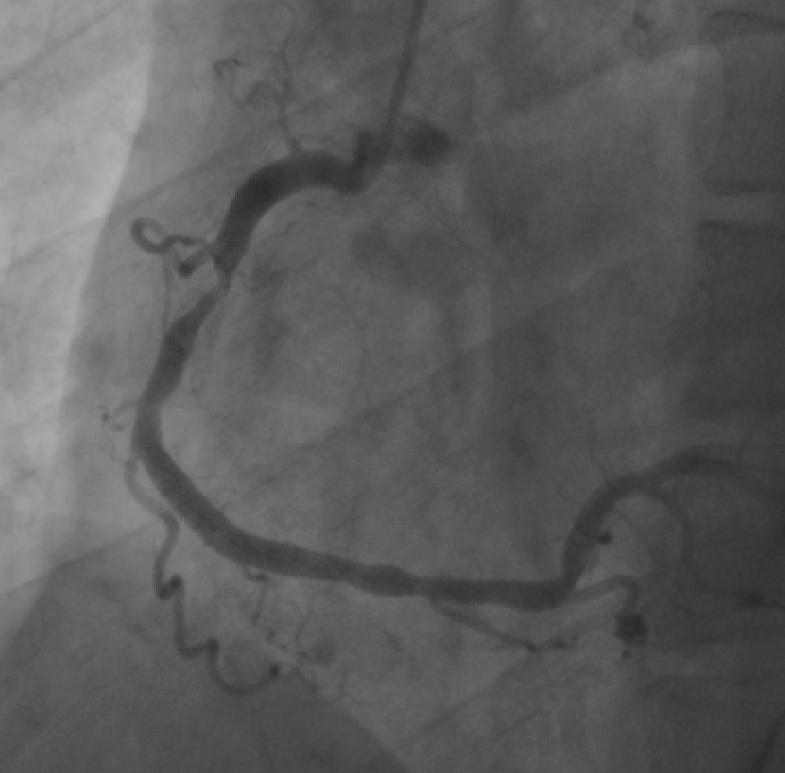Treat or Not treat No Doubt about Stenting!