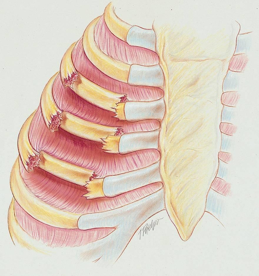 Figure 21-1. Flail chest.