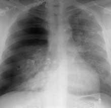Trauma to the innermost region of the chest A. mediastinal emphysema B. cardiac tamponade C.