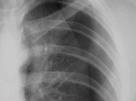 S/S of Simple/Closed Pneumothorax Chest Pain
