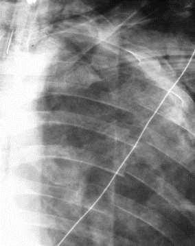 Flail Chest Multiple rib fractures, especially if individual ribs fractured more than