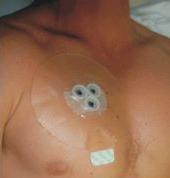 oxygen Cover wound Valved chest seal Occlusive
