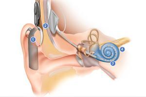 Implantable Devices Cochlear implants An internal device stimulates the nerve with electrical