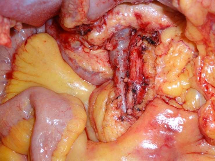 Cancer of the Ascending Colon