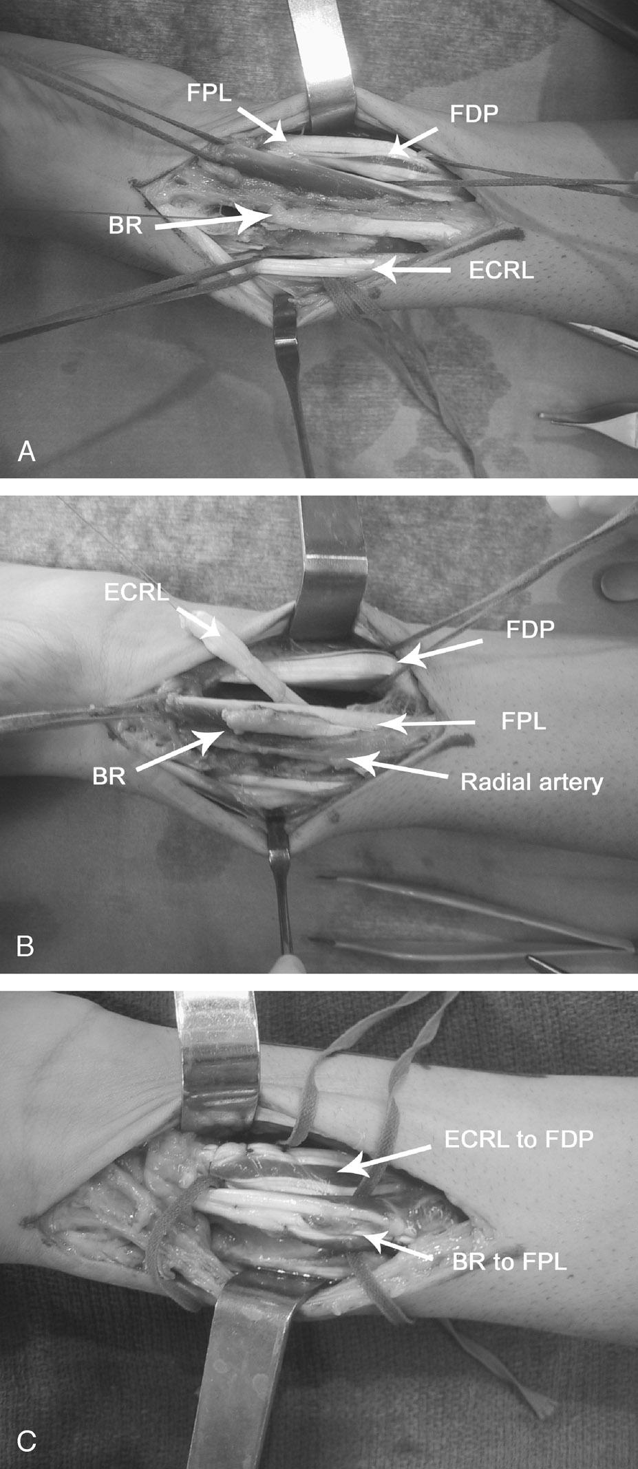 Hand Palsies in C7 to T1 or C8, T1 Root Avulsions Flexor Pollicis Longus Palsy The BR and the FPL tendon are easily isolated. Care must be taken to avoid damage to the radial nerve.
