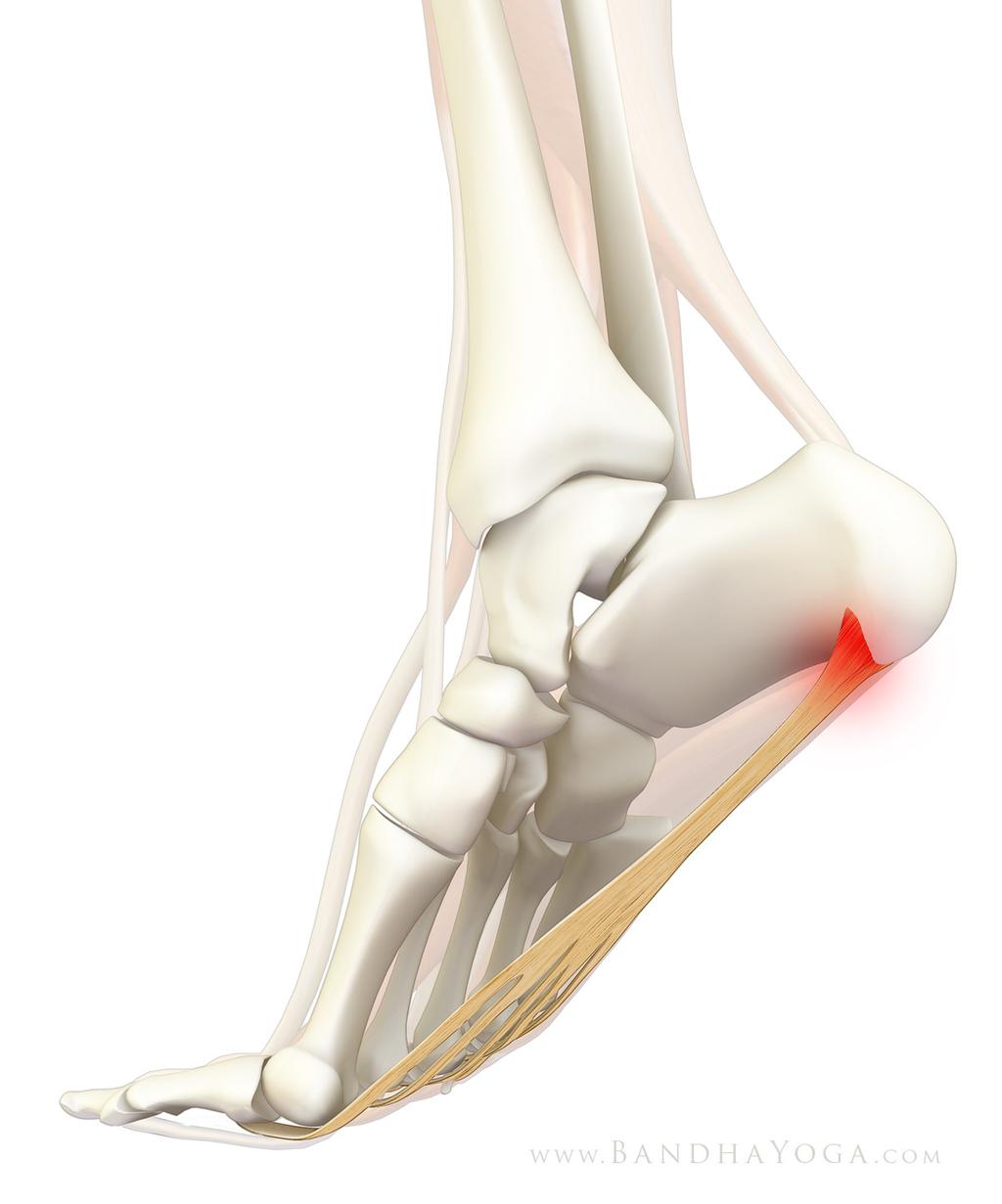 Figure 4: Plantar fasciitis (note the inflammation at the origin of the plantar aponeurosis). Note that there are other conditions that can cause heel pain.