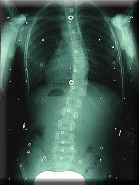 After evaluation of the patient s radiological, clinical and postural data she was