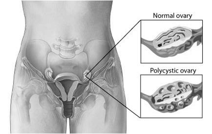 gov/publications/ourpublications/fact-sheet/polycystic-ovary-syndrome.