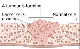 Benign tumors are not cancerous these cells do not spread to other parts of the body Malignant tumors are