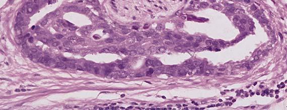 layer of epithelium Gland-within-gland LN and
