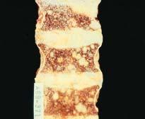 Staging Prostate Cancer Bone Metastases Spinal mets -> Painful May cause