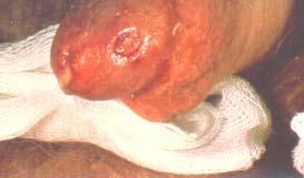 Gonorrhea Neisseria