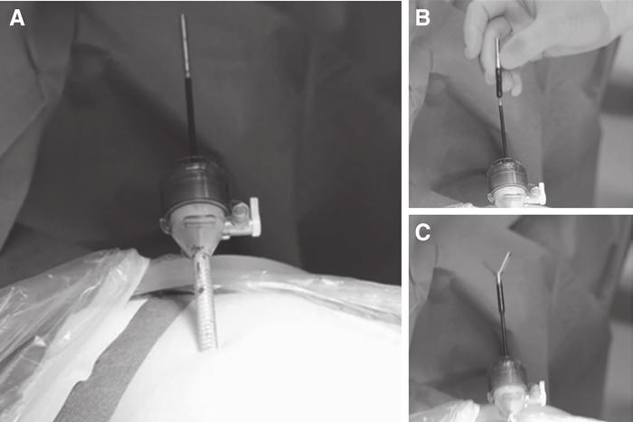 MINILAPAROSCOPY 3 FIG. 2. Extracorporeal instrument exchange. (A) Extracorporealized Veress needle tip. (B) Attaching the 5-mm end effector. (C) End effector engaged and ready to use.