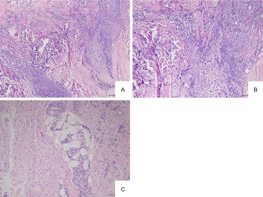 Figure 1. Pathological characteristics of pressure ulcers. A. Loss of epithelial cells and massive infiltration of neutrophils with necrosis are seen. H&E, 100. B.