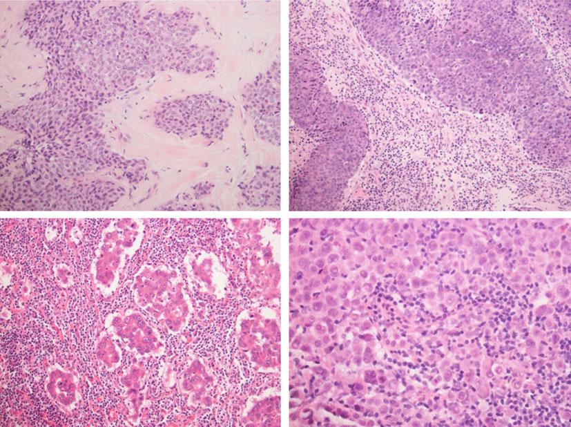 Chapter No.: 12 Date: 28-8-2016 Time: 10:11 am Page: 5/20 12 Tumor Infiltrating Lymphocytes as a Prognostic 5 Fig. 12.2 Various levels of TIL infiltration in different breast cancer samples are shown.