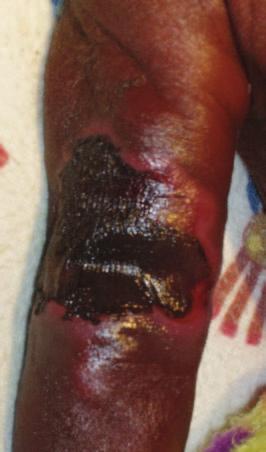 Intravenous infiltration injuries C D Figure 4. Treatment of intravenous infiltration injury with bilayered tissue-engineered skin.. Injury due to dopamine infiltration: before debridement;.