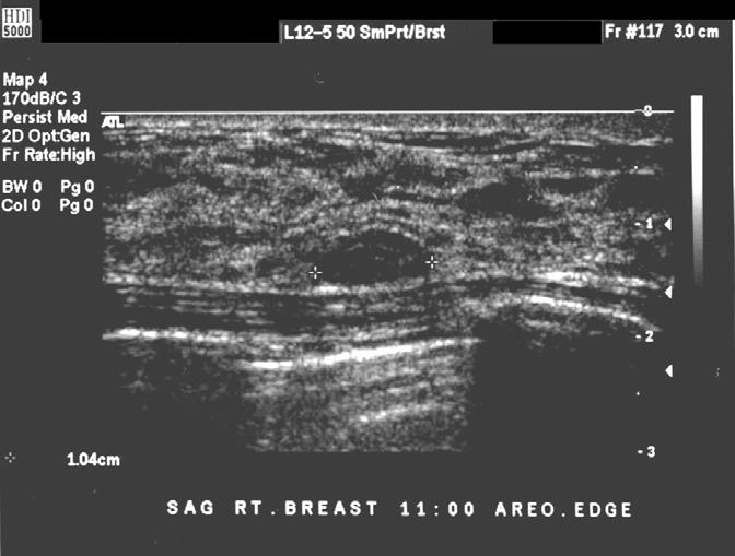 Our Patient - Ultrasound Bilateral benign-appearing hypoechoic nodules on the right (nonpalpable 10 x 12 x 5 mm ovoid