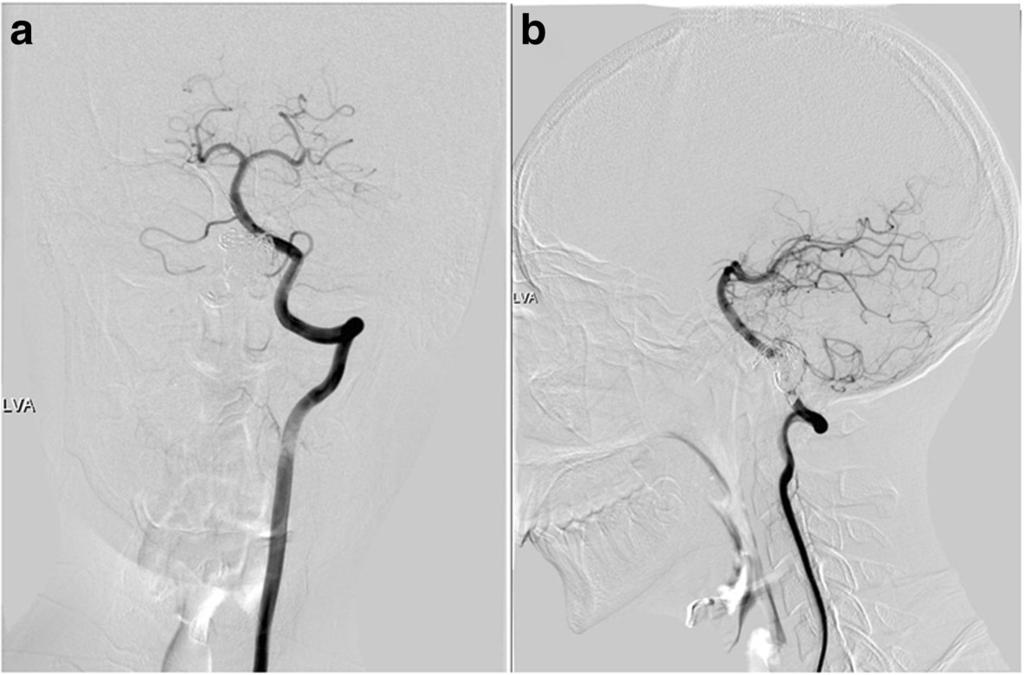 Jiang Chinese Neurosurgical Journal (2017) 3:35 Page 5 of 6 Fig. 4 Catheter angiography at 15 months (Fig. 4), both anteroposterior (a) and lateral (b) views were displayed.