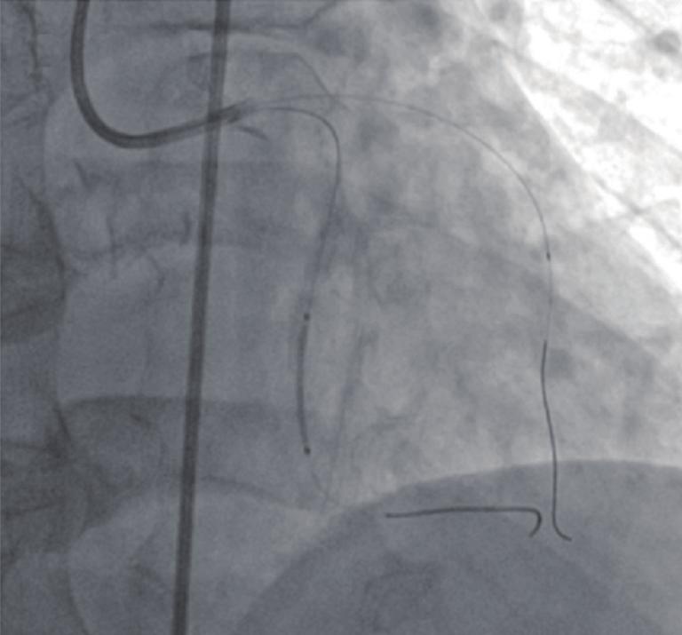 1. (A,B) Angiogram showing a severe stenosis located at the distal segment and ostium of the left
