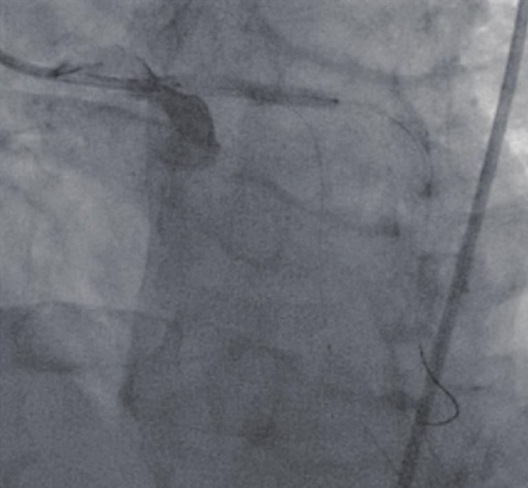 5 mm 24 mm stent is deployed in the distal LCX coronary artery, and a 3.