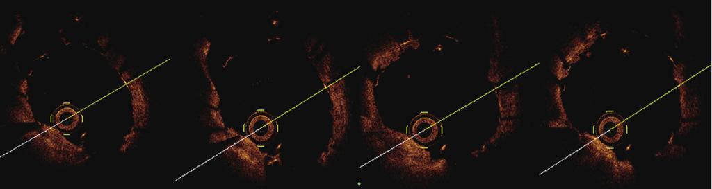 Journal of Thoracic Disease, Vol 9, No 3 March 2017 E199 Figure 2 Optical coherence tomography (OCT) image showing that once