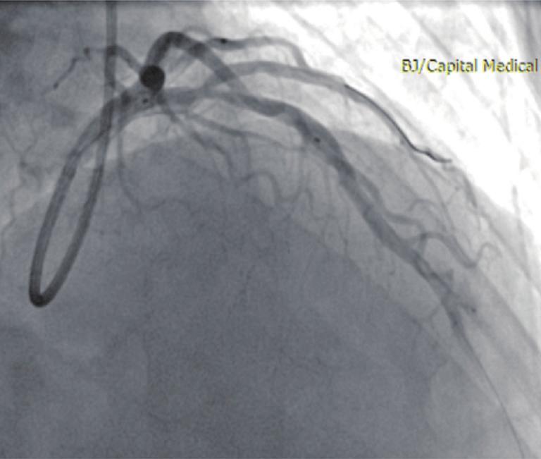 (A) Coronary angiogram showing severe stenosis at the middle segment of the LAD involving the ostium of the diagonal artery;