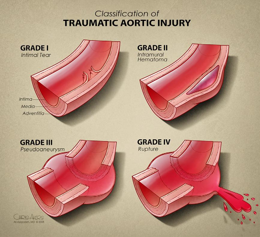 JOURNAL OF VASCULAR SURGERY Volume 57, Number 1 Azizzadeh et al 109 Fig 1. Classification of traumatic aortic injury. retrospective review of hospital financial accounts.