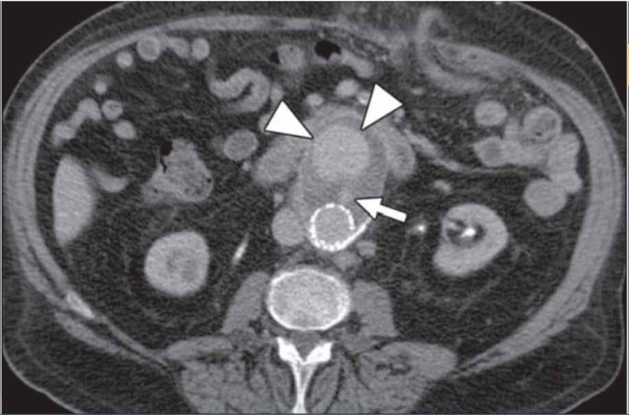 Delayed Phase CT - 7 months post-evar: Large contrast collection in the aneurysmal sac, neck of contrast leading to the