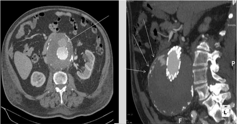 Type II Endoleak - Axial and sagittal images of contrast enhanced CT show an endoleak caused by collateral flow