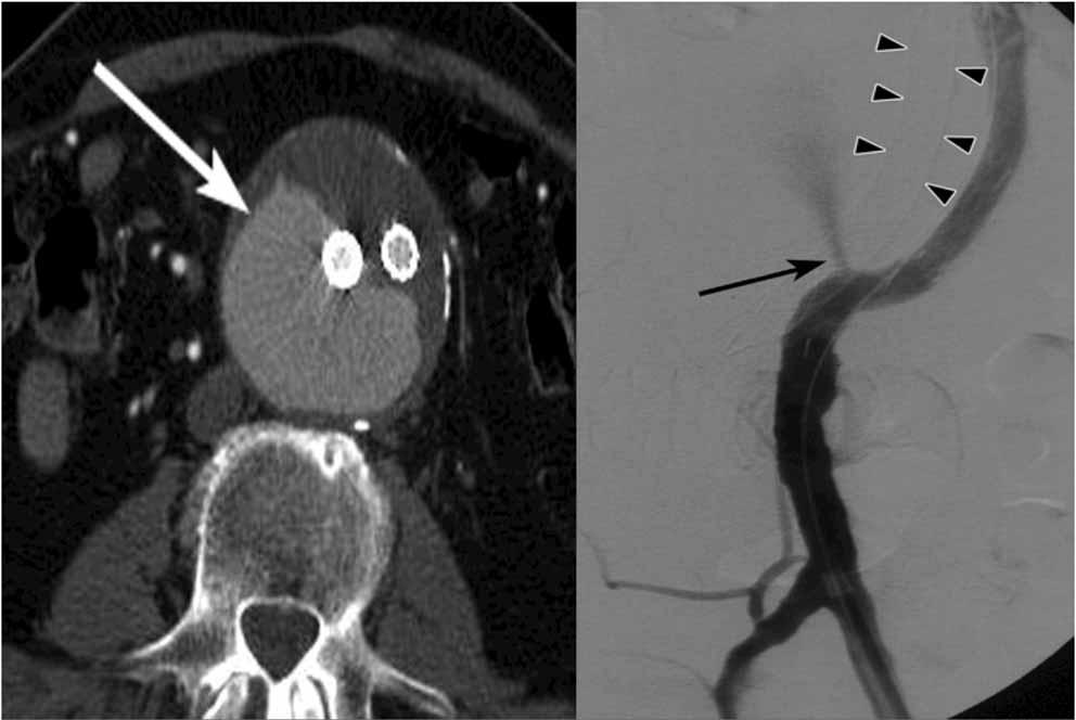 CT with Digital Subtraction Angiogram: Large central contrast material collection, angiogram