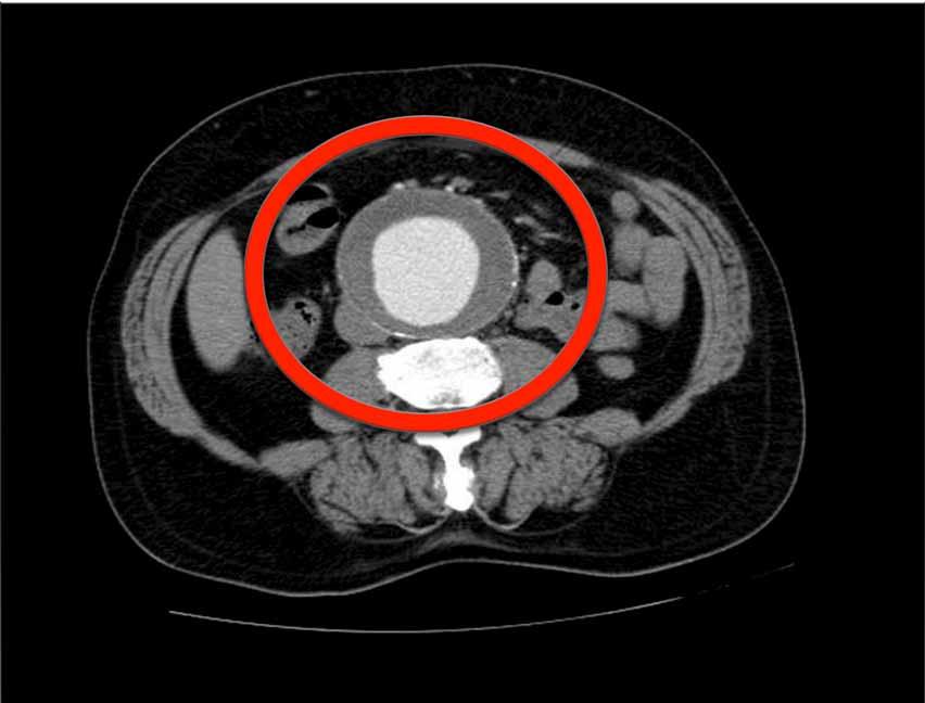 Contrast enhanced CT: Dilated abdominal aorta with surrounding thrombosis
