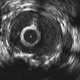 3/25/2013 Three Studies Have Suggested that Patients with Bifurcation Lesions Treated with IVUS Guidance Do Better Long-term than Patients with Bifurcation Lesions Treated with Angiographic Guidance