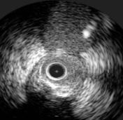 IVUS imaging of only the main branch of the main vessel is, at best, inferential