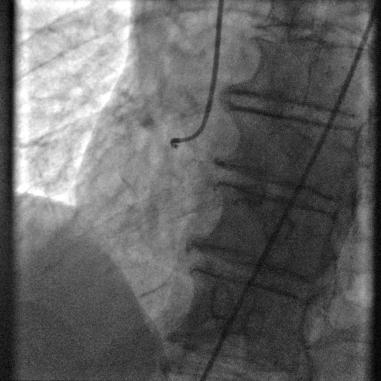 3/25/2013 Right Coronary Artery Left Coronary Artery FFR in Culprit Lesions: Subacute Setting Flow = Pressure Gradient / Resistance Normal microvasculature