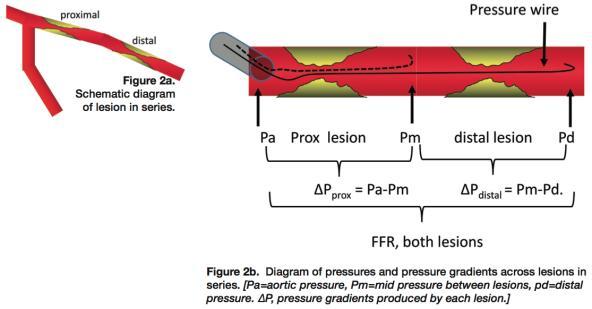 FFR of Two Lesions in Series How to Predict FFR of Individual Lesion [FFR predicted = (P d -[(P m /P a )*P w ])/((P a -P m )+(P d -P w )) This calculation requires pressure distal (Pd), pressure