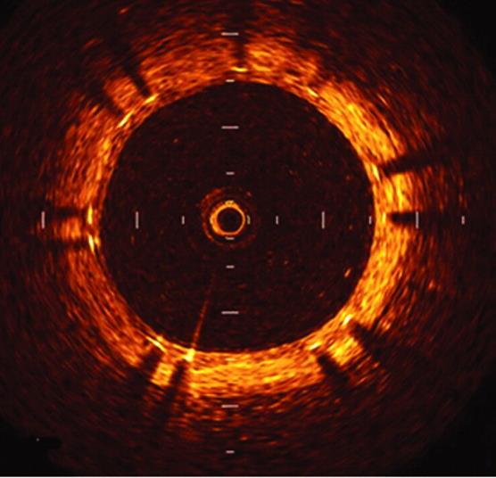 Optical CoherenceTomography The typical OCT image has a homoaxial resolution of 10 μm,